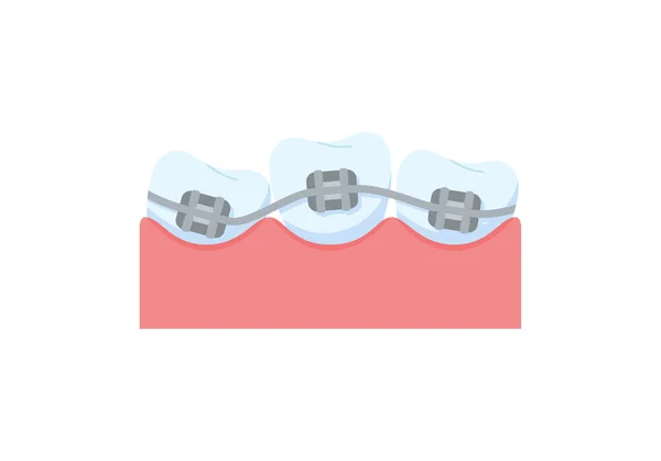 矯正フラットスタイルのための金属ブレースと歯 白い背景に隔離されたベクトルイラスト 歯のアラインメント 歯のブレースと歯の概念 — ストックベクタ