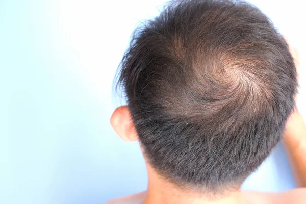 Tampilan Konsep Hair Loss — Stok Foto