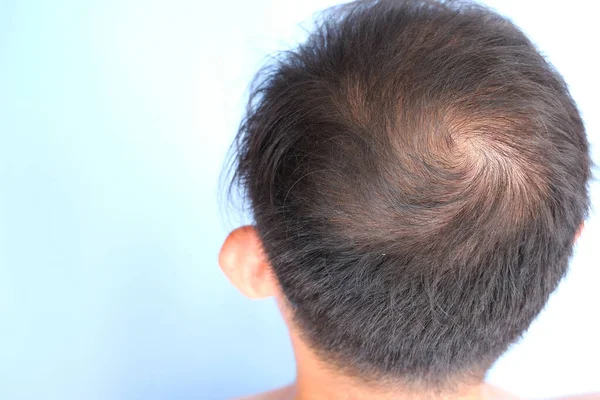 Tampilan Konsep Hair Loss — Stok Foto