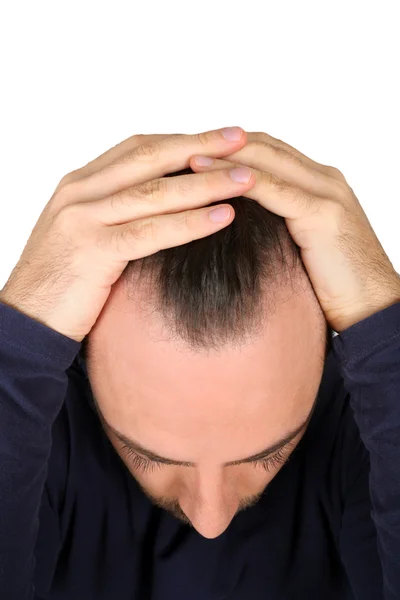 男人控制脱发 — 图库照片