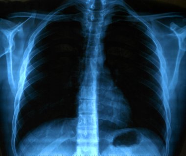 İnsan Sağlıklı Göğsünün X-Ray görüntüsü