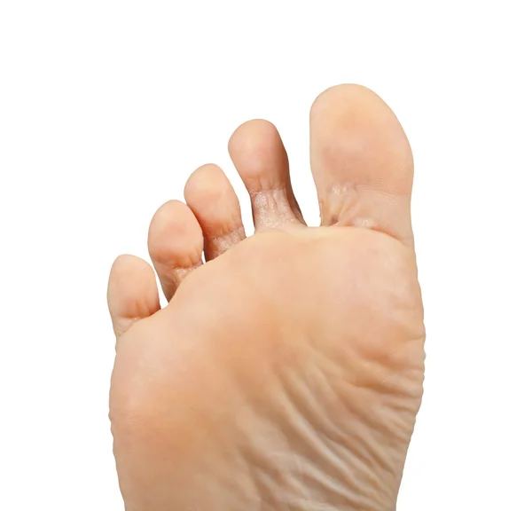 Athlete's foot, Tinea pedis — Stock Photo, Image