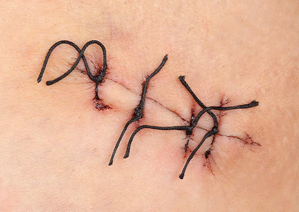 Herida con puntada quirúrgica — Foto de Stock