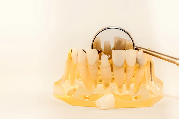 Anterior full porcelain crown and abutment — Stock Photo, Image
