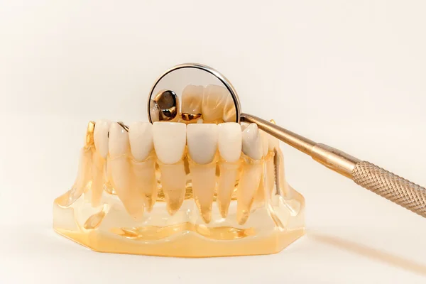 Anterior crown on gold core — Stock Photo, Image