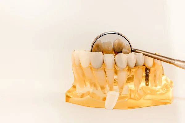 Porcelain veneers and prepaired lateral incisor on model — Stock Photo, Image