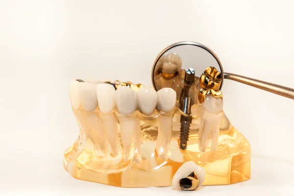 Pfm und Implantat auf Modell auf weißem Hintergrund — Stockfoto