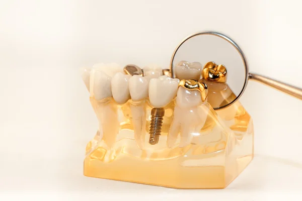 Gold onlay cemented on molar — Stock Photo, Image