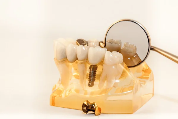 Gold onlay and prepaired molar on model — Stock Photo, Image