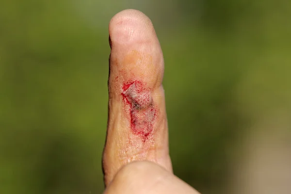 Рана на мужском пальце — стоковое фото