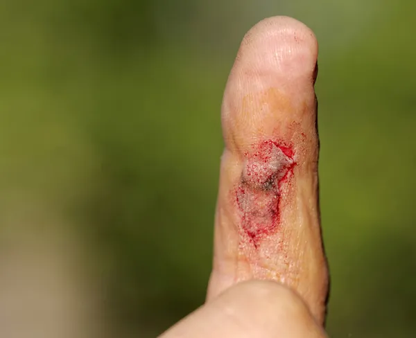 Wound on male finger — Stock Photo, Image