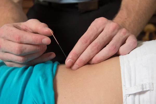 Agulha de acupuntura paciente do sexo feminino costas e coluna vertebral — Fotografia de Stock