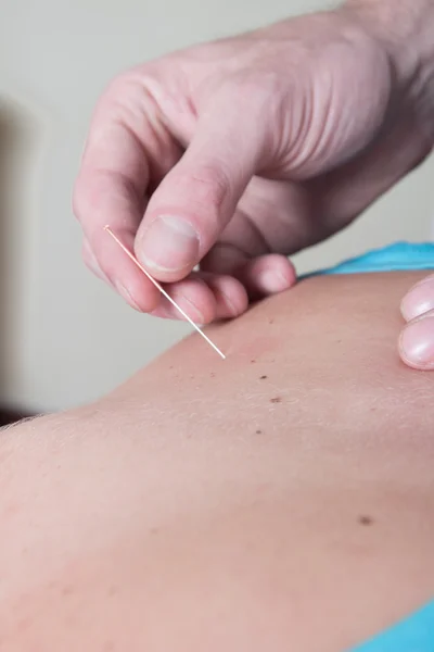 Chiropractor using acupuncture Female patient neck — Stock Photo, Image