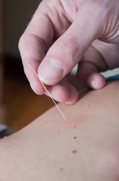 Agulha de acupuntura quiroprático de doente do sexo feminino — Fotografia de Stock