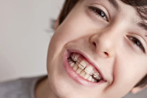 Adolescente feliz com aparelho — Fotografia de Stock