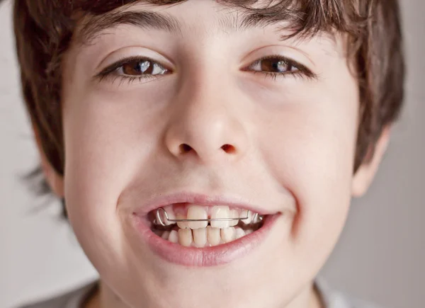 Adolescente feliz com aparelho — Fotografia de Stock