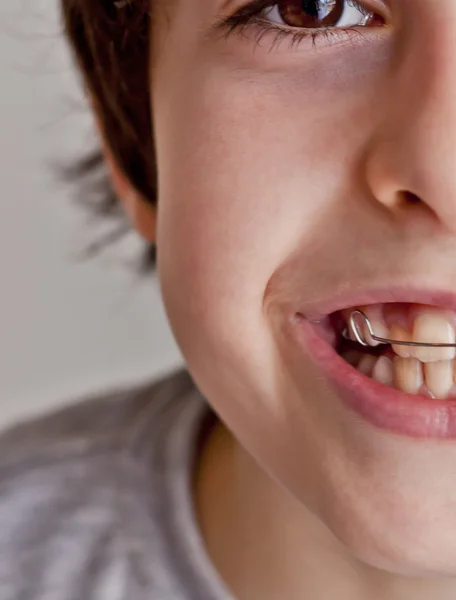 diş teli ile mutlu teen