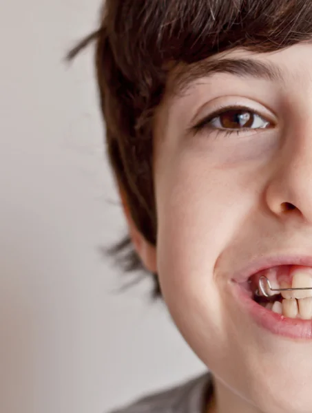 Adolescente feliz com aparelho — Fotografia de Stock