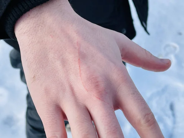 Scratch on a hand, close up — Stock Photo, Image
