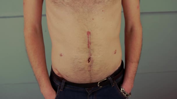 Bărbat fără cămaşă anonim cu cicatrici pe corp. Crop de sex masculin de nerecunoscut cu cicatrici pe corp după operație în picioare lângă perete cu mâinile în buzunare în cameră ușoară — Videoclip de stoc