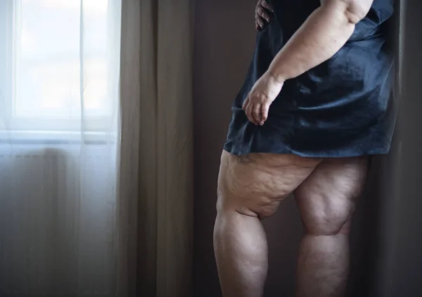Mulher gorda com celulite nas pernas, cortada. — Fotografia de Stock