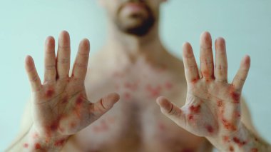 Çiçek hastalığı ya da yeşil arka plandaki diğer viral enfeksiyonlar yüzünden kızarıklıktan etkilenen bir erkek eli.