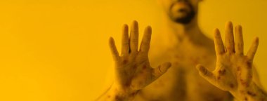 a Male hands affected by blistering rash because of monkeypox or other viral infection on yellow background, wide banner. clipart