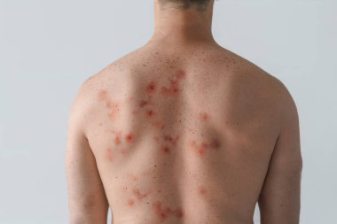 A male back affected by blistering rash because of monkeypox or other viral infection on white background clipart