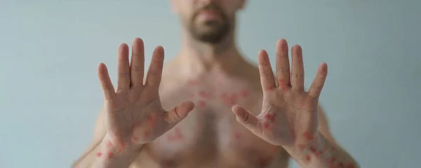 白血球のために水疱性発疹や他のウイルス感染症によって影響を受ける男性の手 — ストック写真