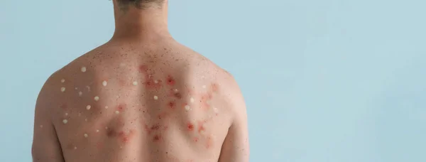 Male Back Affected Blistering Rash Because Monkeypox Other Viral Infection — Stock Photo, Image