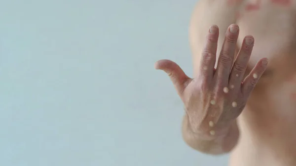 Manlig Händer Påverkas Blåsor Utslag Grund Apkoppor Eller Annan Virusinfektion — Stockfoto