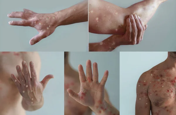 水痘などのウイルス感染による水疱性発疹の影響を受ける男性の体の部位 — ストック写真