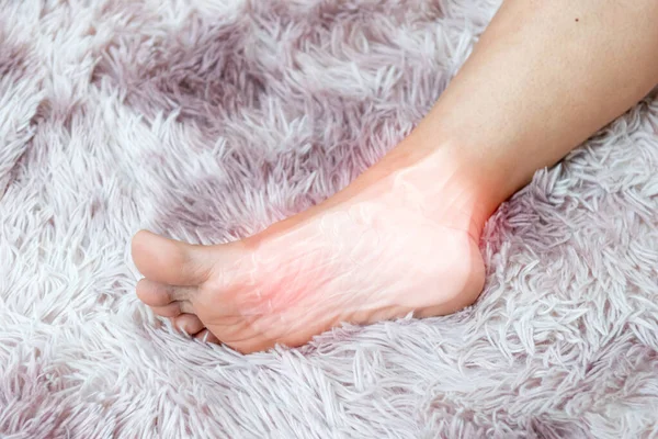 soles inflammation of the human foot bones