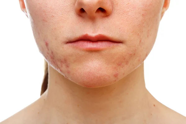 Adolescent girl suffering in acne — Stock Photo, Image