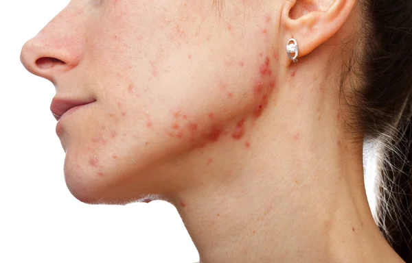 Jeune fille avec problème de peau — Photo