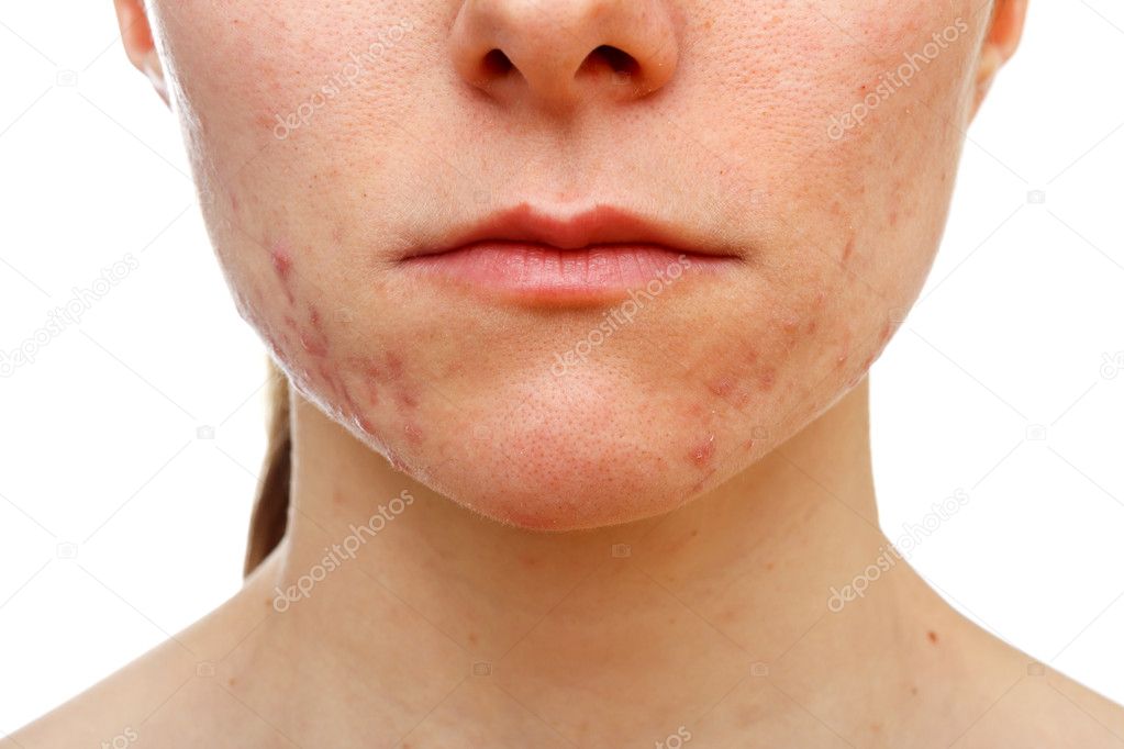 Adolescent girl suffering in acne