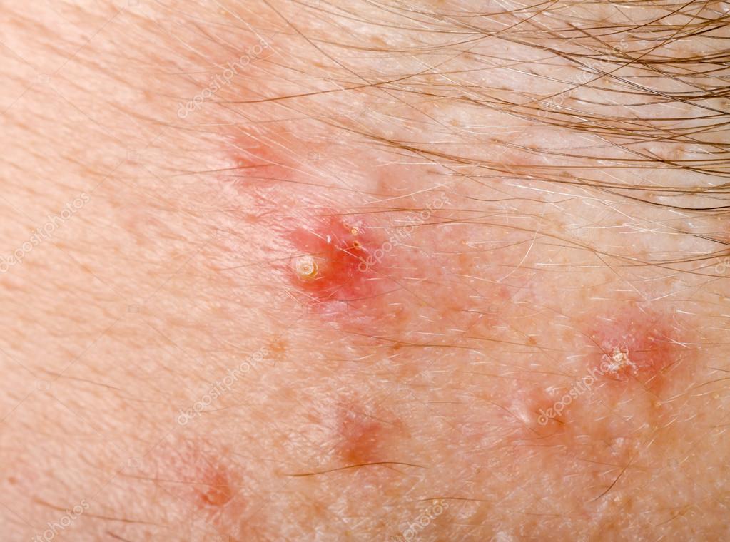 Pimple On Human Skin Macro Stock Photo By ©obencem 18607053