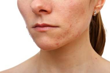 Young girl with skin problem