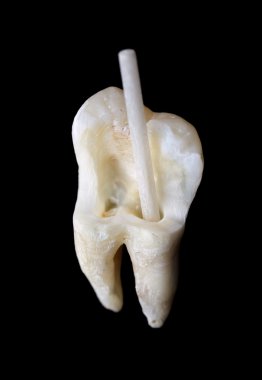 Human tooth with fiber resin post clipart