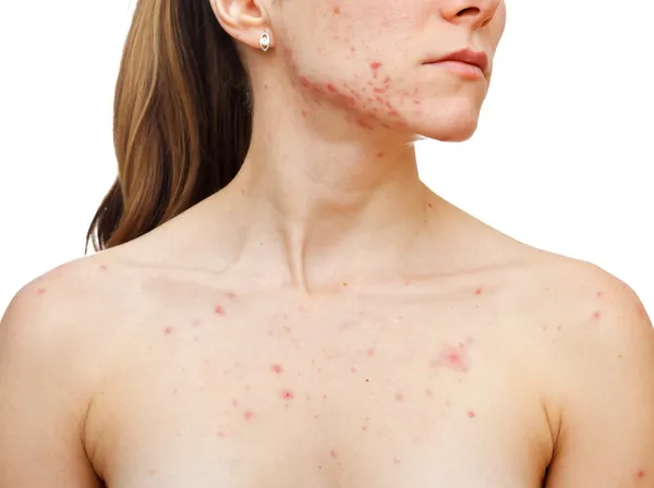 Skin problems — Stock Photo, Image