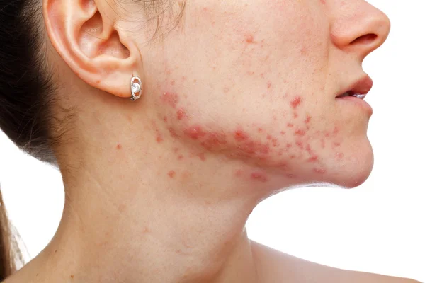 Jeune fille avec problème de peau — Photo