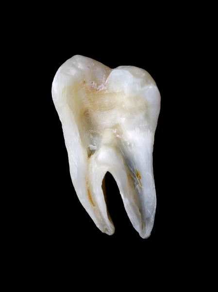 Längdsnitt från en mänsklig tand — Stockfoto