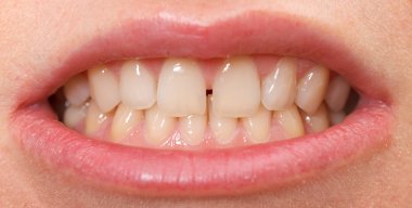 diastema üst kesici dişler arasında