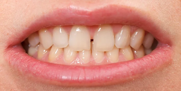 Diastema entre os incisivos superiores Imagem De Stock