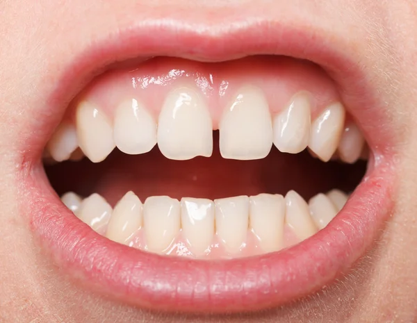 Diastema entre os incisivos superiores — Fotografia de Stock