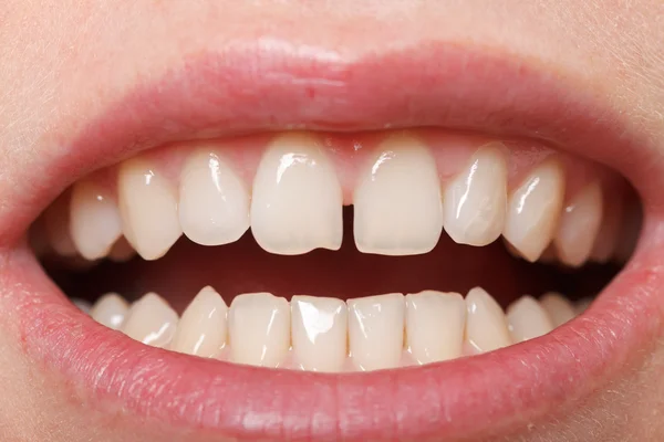 Diastema entre os incisivos superiores — Fotografia de Stock