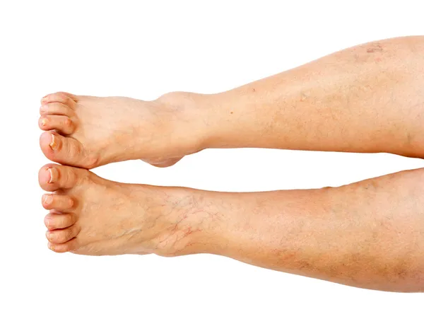 Lower extremity disease — Stock Photo, Image