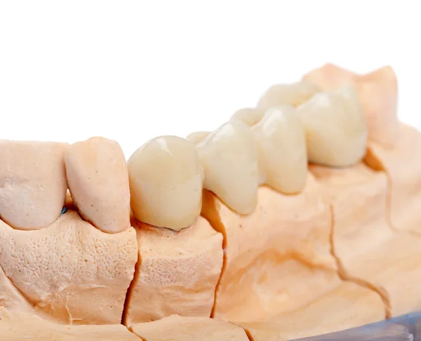 Teeth rehabilitation — Stock Photo, Image