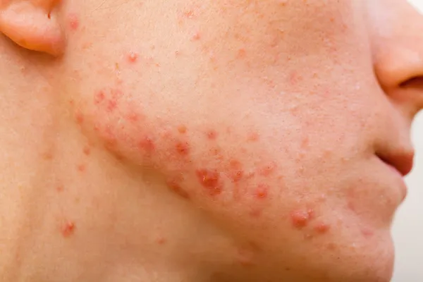 Acne skin — Stock Photo, Image