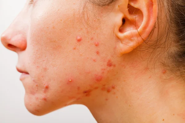 Acne huid — Stockfoto